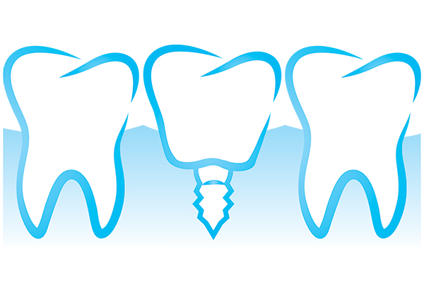 Replace Multiple Missing Teeth With All On  ®