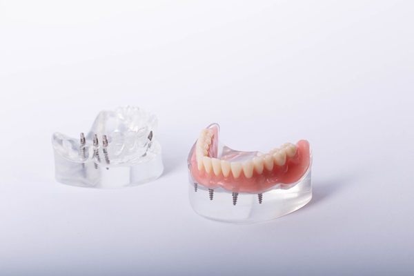 How Do All On  ® Dental Implants Work?