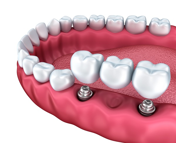 General Dentist: Reasons To Choose Dental Implants